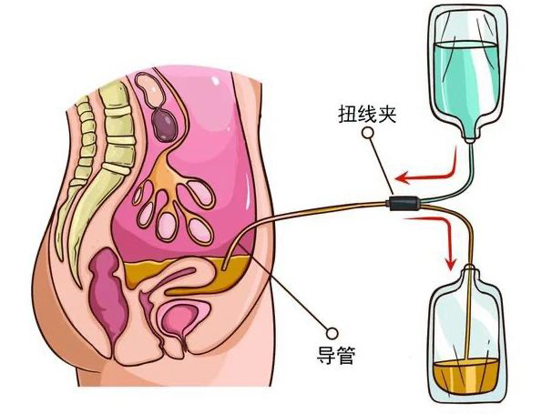 優(yōu)勢學(xué)科｜腎臟替代治療——醫(yī) 護(hù) 患一體化腹膜透析管理模式