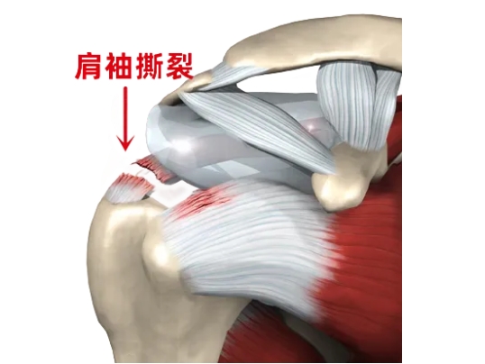 優(yōu)勢(shì)技術(shù)|肩袖損傷：肩關(guān)節(jié)鏡下縫合肩袖 小切口解決大麻煩