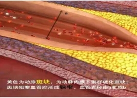特色門診 | 頸動(dòng)脈斑塊專科門診