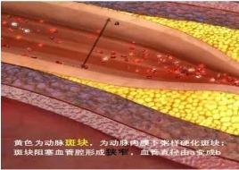 特色門診 | 頸動脈斑塊?？崎T診