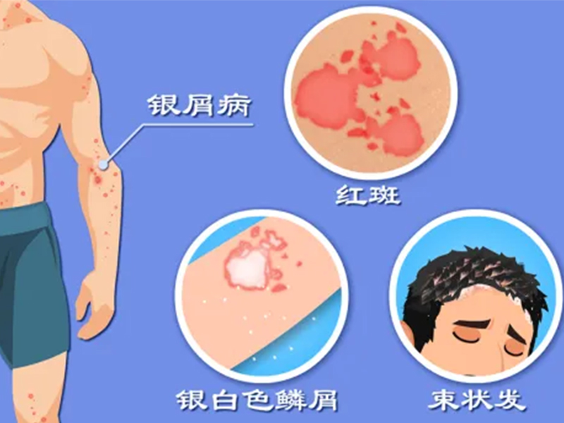 特色門診|銀屑病?？崎T診