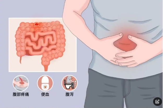 優(yōu)勢(shì)技術(shù)|消化一科運(yùn)用生物制劑治療炎癥性腸病