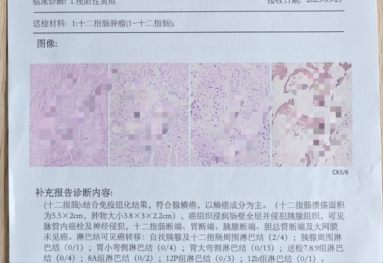 優(yōu)勢(shì)技術(shù)|普外二科：勇闖胰十二指腸手術(shù)禁區(qū) 攻克高難度十二指腸占位病變
