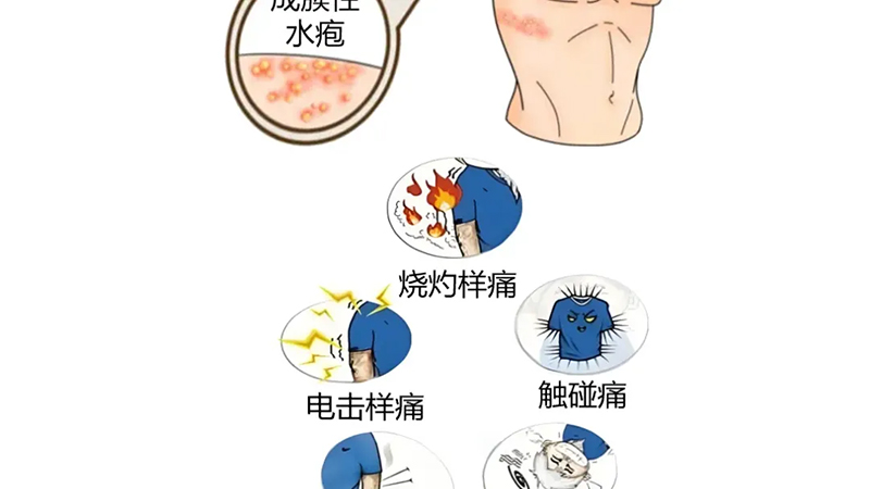 藥學(xué)科普|帶狀皰疹如何正確用藥？這幾點一定要知道！