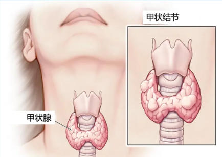 特色門診|甲狀腺結(jié)節(jié)門診正式開診！3分鐘讀懂“切還是不切